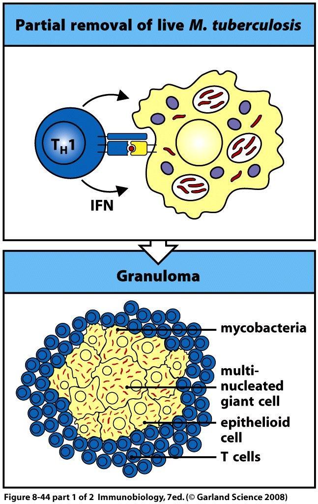 When the immune system cannot complete eliminate the mycobacteria, a granuloma forms.