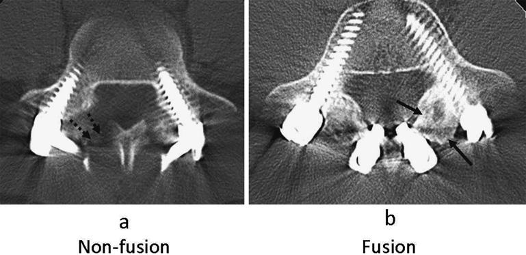Spine Surg Relat Res 2018; 2(2): 135-139 Figure 1. Bone fusion was evaluated by computed tomography.