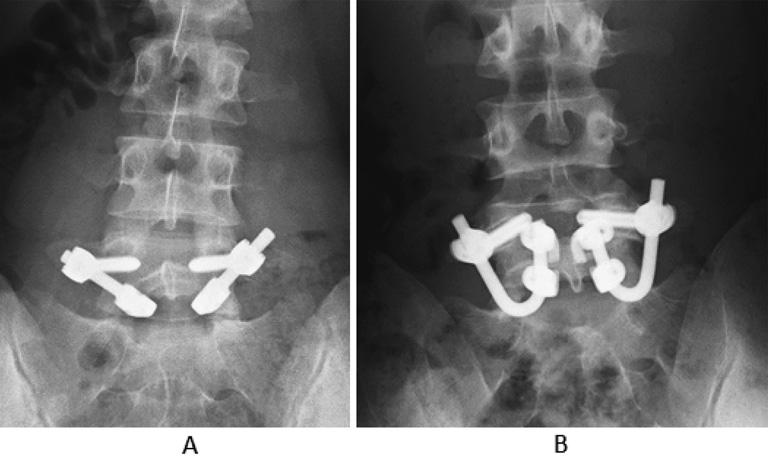 (c). Figure 3. Antero-posterior radiographs of pedicle screw hook fixation (A) and pedicle screw claw-hook fixation (B).