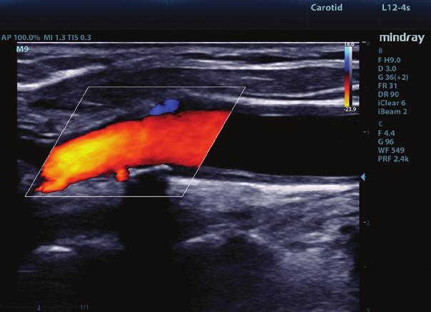 Vascular Delivering excellence in color Doppler sensitivity with intuitive workflow, vascular imaging with the M9 is fast, accurate,