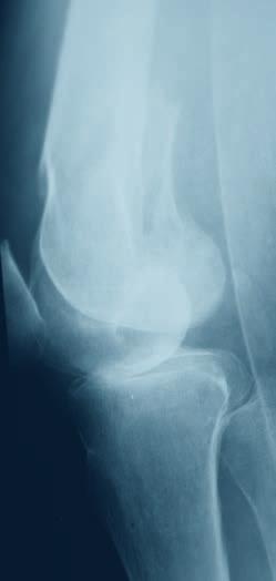 fractures Supracondylar fractures Intra-articular