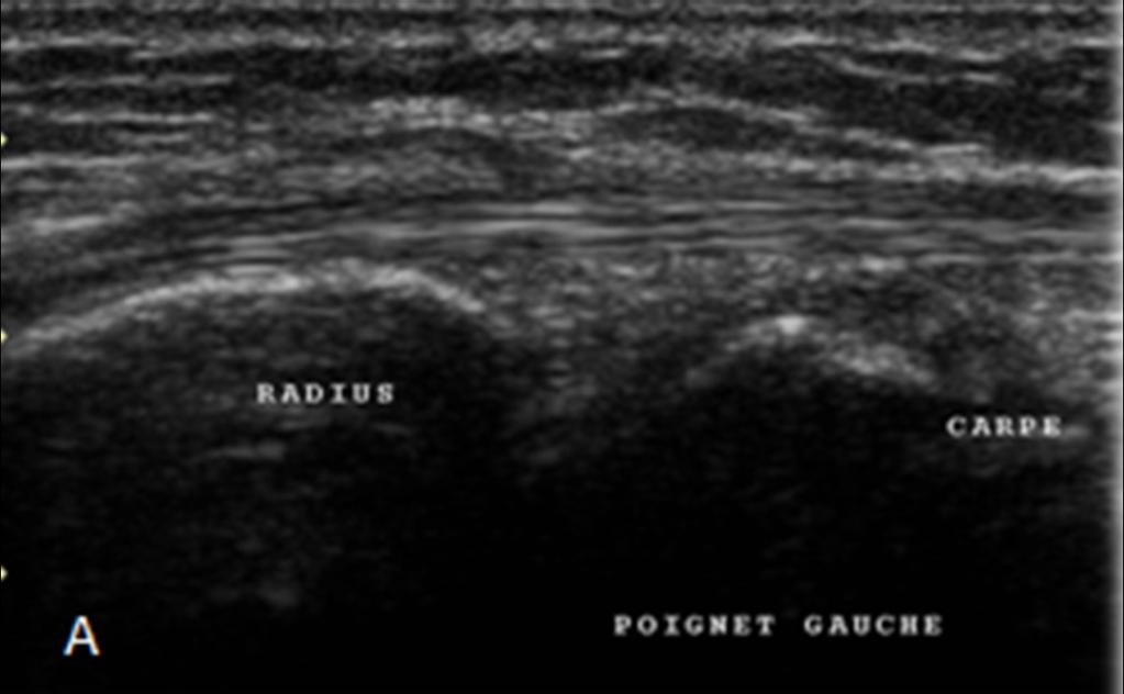 Fig. 2: Normal sonographic appearances of the radiocarpal joint.