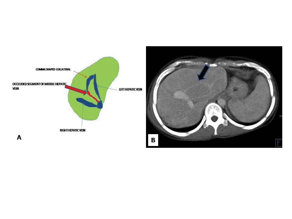 Figure 1 Diagram (A) and CECT abdomen axial section (B) displaying comma shaped intrahepatic veno-venous collaterals