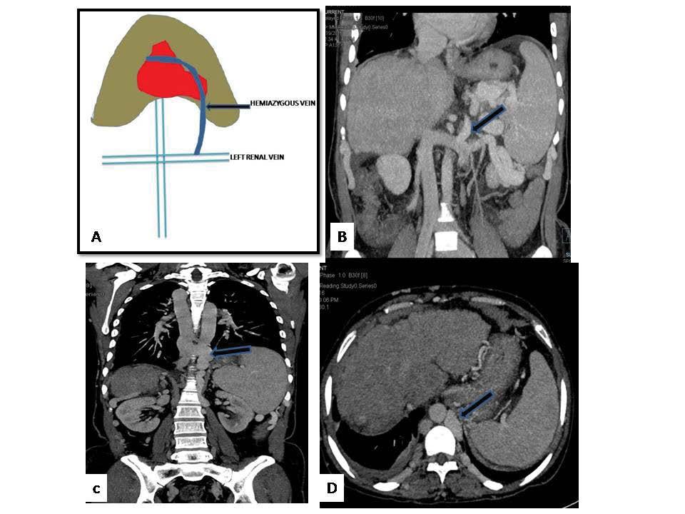 Figure 2 Diagram (A) and CECT abdomen coronal (B and C) and axial (D) sections displaying left renal hemiazygous pathway.