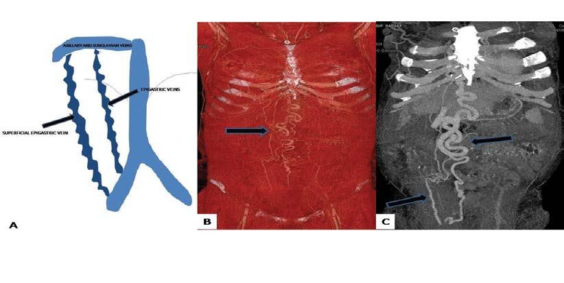 Collaterals comprising the superior and inferior epigastric communications are seen medially in contrast to the posterolaterally situated superficial epigastric and lateral thoracic veins.