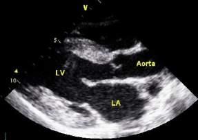 heart) Assess RV & RA chamber sizes + CFM Screen for MV Screen for TV Ao + LV Assess appearance