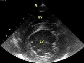 be performed in PLAX view, if this images better Assess LV chamber size, function and wall