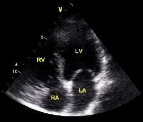 Ao diameter Ensure symmetry and good visualisation of 3 aortic valve