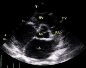 maximal length of RVOT to pulmonary artery visualised Assess