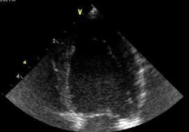 rule) in diastole and systole and EF%) Ensure endocardium is visible