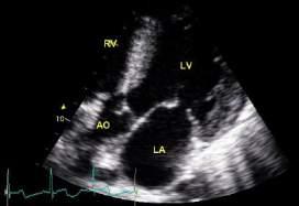 velocity Tricuspid inflow Place cursor at level of TV leaflet tips and