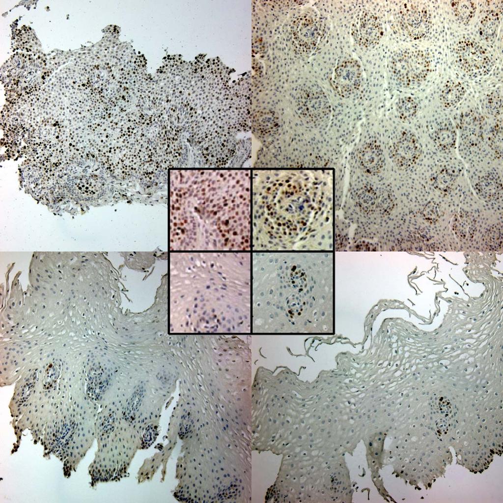 Pre-Rx MIB1 Immunohistochemistry Pre-Rx A Post-Rx B Normal These results indicate that the epithelial layer thickening in
