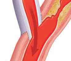 Treating CAD: Coronary Artery Bypass Surgery Sometimes, angioplasty and stenting can t do enough to improve blood flow. If so, coronary artery bypass surgery is often advised.