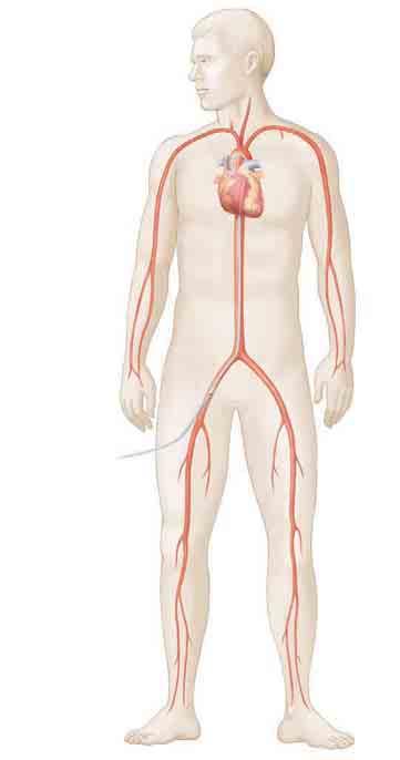 Arm insertion site Wrist insertion site Groin insertion site Catheter Heart Evaluating Coronary Arteries Contrast fluid is injected through the catheter into the artery.