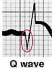 ECG Changes: Infarct Significant Q-wave where none previously existed Why? Impulse traveling away from the positive lead Necrotic tissue is electrically dead No Q-wave in Subendocardial infarcts Why?