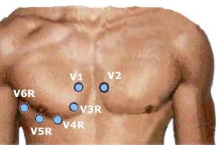 Right Sided EKG???? The single most accurate tool used in measuring RVI.