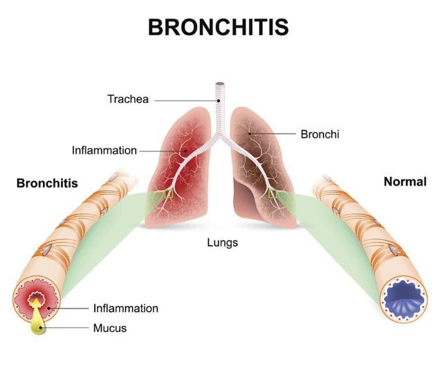 BRONCHIECTASIS Bronchitis is an inflammation of the bronchi. In chronic bronchitis the airways become narrow, scarred, and partly clogged with mucus, making it difficult to breathe.