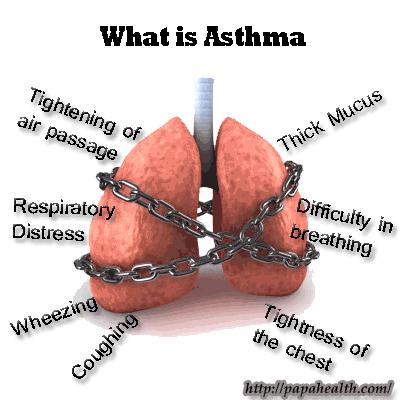 ASTHMA It is a chronic disease that affects the airways of the lungs.