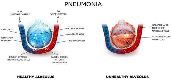 PNEUMONIA Pneumonia is typically caused by a virus or bacteria to which individual is expose in the environment or is passed from another person.