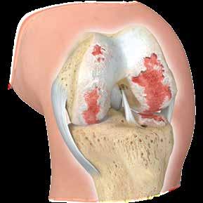 The ends of the bones in the knee joint are covered with cartilage, a tough, lubricating tissue that helps provide smooth, pain-free motion to the joint.