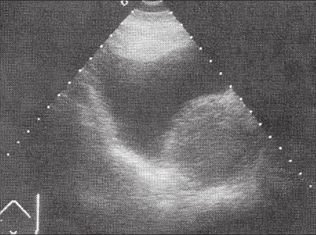 Upala prostate/infekcije urotrakta 61 SLIKA 1. Ultrasonografski prikaz akutnog prostatitisa vidljiva je povećana prostata, bez drugih karakterističnih ultrasonografskih znakova SLIKA 2.