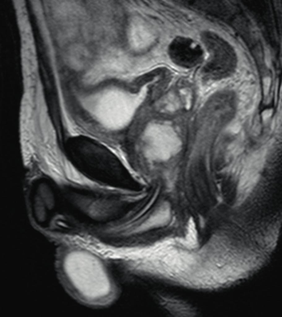 Upala prostate/infekcije urotrakta 63 SLIKA 5. UMR-prikaz opsežnog apscesa prostate SLIKA 6.