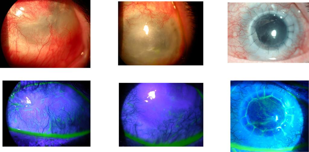 Solomon Techniques in Ophthalmology & Volume 7, Number 3, September 2009 FIGURE 6.