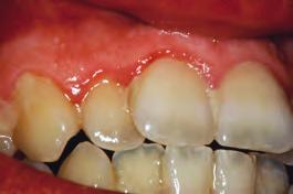 Causes of Gum Disease Plaque is a sticky film that is always on your teeth. Bacteria that live in the plaque can cause your body to react and make your gums become red, puffy and swollen.