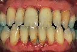 p Periodontitis Gums Ligament Bone Inflamed gums Tartar In time, your body responds to the toxins that the bacteria produce by breaking down the gum tissues and