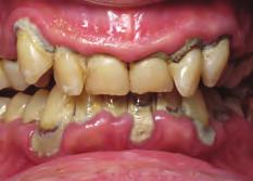 Loose or missing teeth can create problems, like making it hard for your to eat the foods you like.