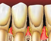 Diseases that affect the whole body such as diabetes and HIV infection lower your body s resistance to infection, including gum disease.