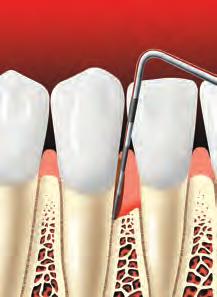 Checking for Gum Disease Your dentist or hygienist uses an instrument called a periodontal probe to gently measure the depth of the pockets around each tooth.