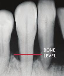 X-ray showing bone loss. Treating Gum Disease Your gum disease treatment will depend on factors such as your personal health history and the stage of your gum disease.