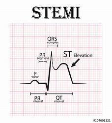 Plaque ruptures and thrombus forms around the ruptured plaque causing partial occlusion of the vessel Pain occurs at rest Pain is more intense and lasts longer than stable angina EKG = Normal,