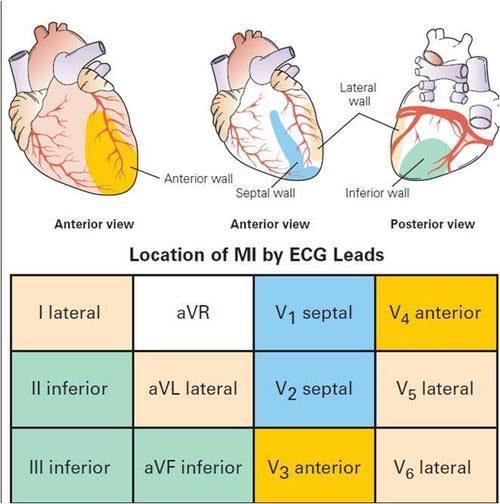 Anterior MI Left Coronary and Left Anterior Descending Artery (LAD) Anterior wall of LV and ventricular septum 2 nd