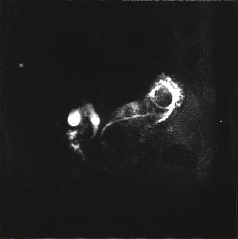 one of CT, MRCP or direct cholangiographic images, and also shown to have malignant distal CBD strictures according to PTCS findings and biopsies.