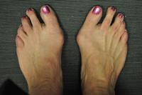 This deformity will gradually increase and may make it painful to wear shoes or walk. Anyone can get a bunion, but they are more common in women.