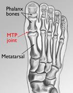 The metatarsophalangeal (MTP) joint.