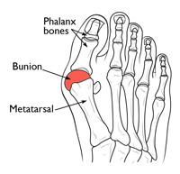 toward the second toe. The MTP joint gets larger and protrudes from the inside of the forefoot. The MTP joint becomes enlarged and inflamed. The enlarged joint is often inflamed.