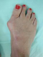 Bunion Progression Bunions start out small but they usually get worse over time (especially if the individual continues to wear tight, narrow shoes).