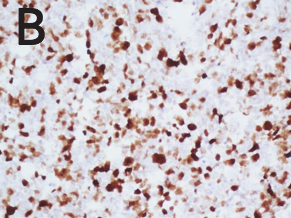 (d) H&E image of a highly cellular neoplasm, composed of small- to medium-sized cells with hyperchromatic nuclei and little cytoplasm; rosette formation is rarely seen; mitotic figures and necrosis