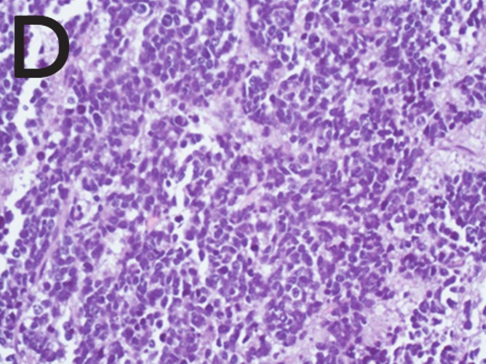 ETs of central origin such as our case are rare proliferative and highly aggressive neoplasms.
