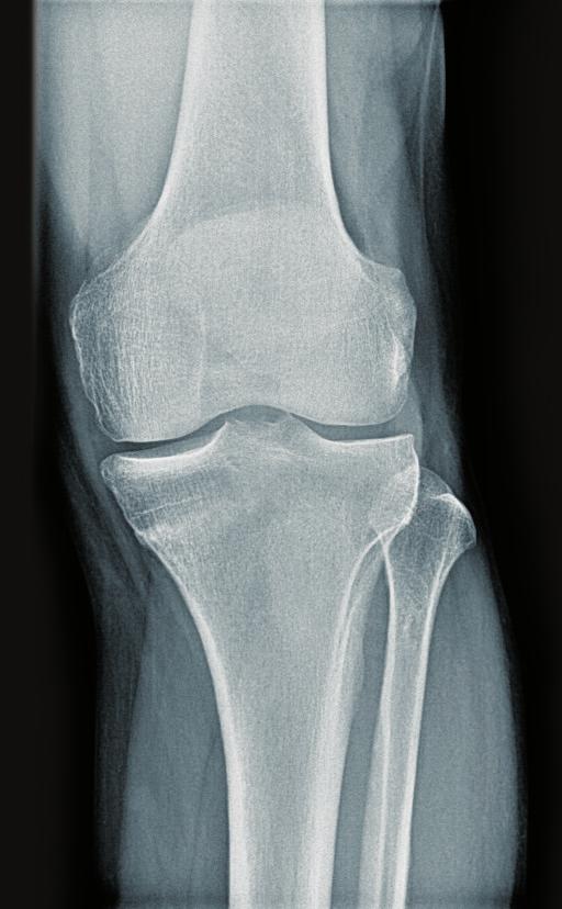 in the left knee after jogging. The first x-ray was normal.