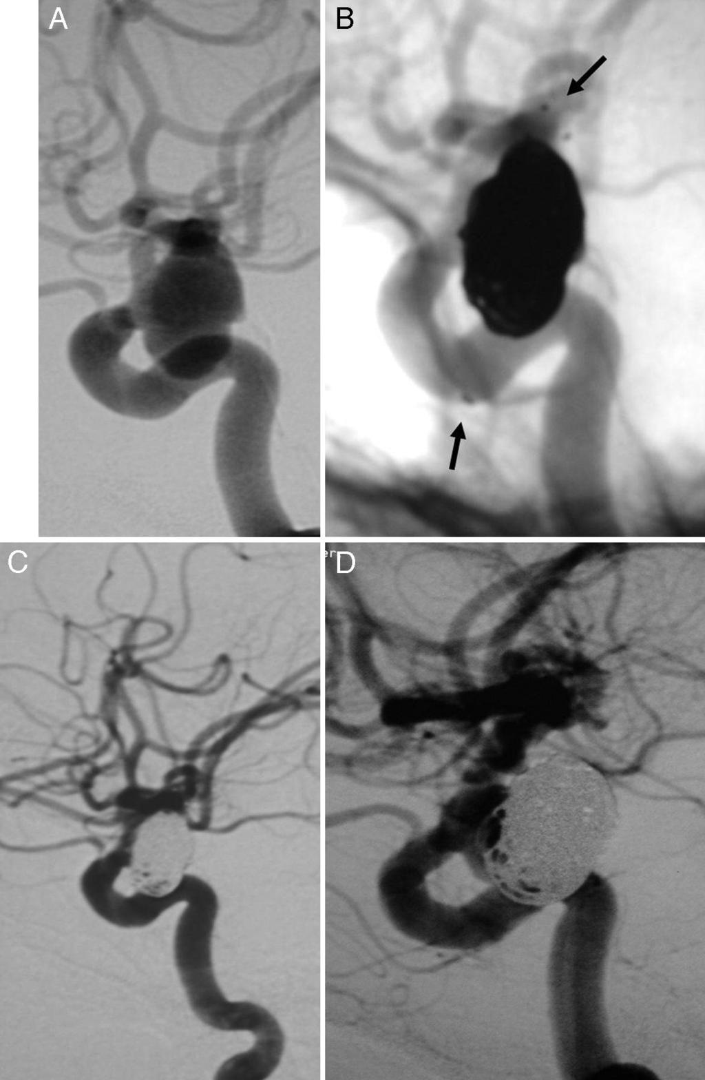 K. Yavuz et al. FIG. 4. A: Pretreatment lateral carotid artery angiogram showing a broad-necked ICA aneurysm.