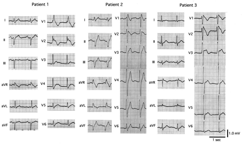 332 Kurita et al. JACC Vol. 40, No. 2, 2002 ST Elevation in Brugada Syndrome July 17, 2002:330 4 Figure 1. Twelve-lead electrocardiogram (ECG) tracings in three patients with a Brugada-type ECG.