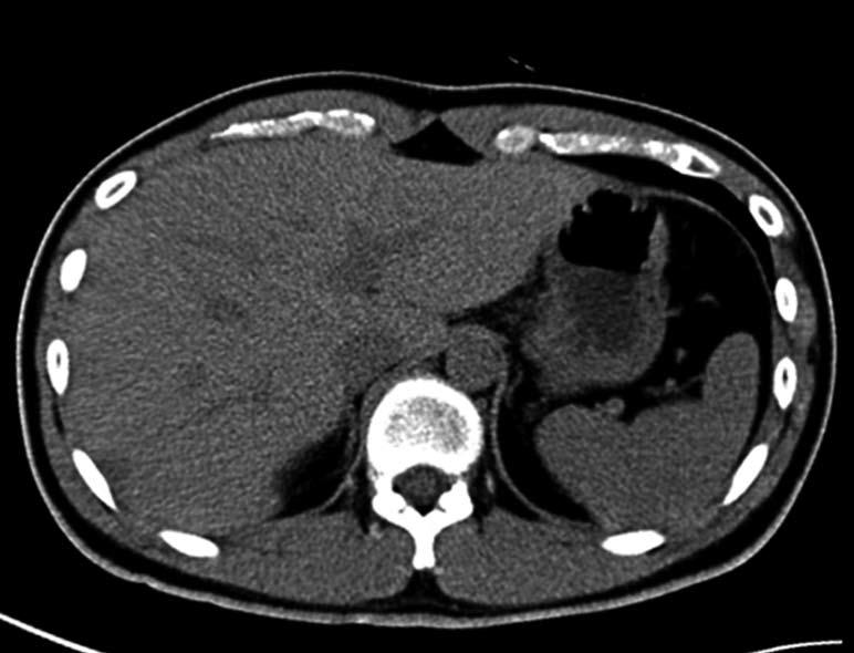 A: Computed tomography (CT) image of a normal liver, showing that its attenuation (65 HU) measured using regions-of-interest (white circles) was higher than that of the spleen (50 HU), and the CTL-S