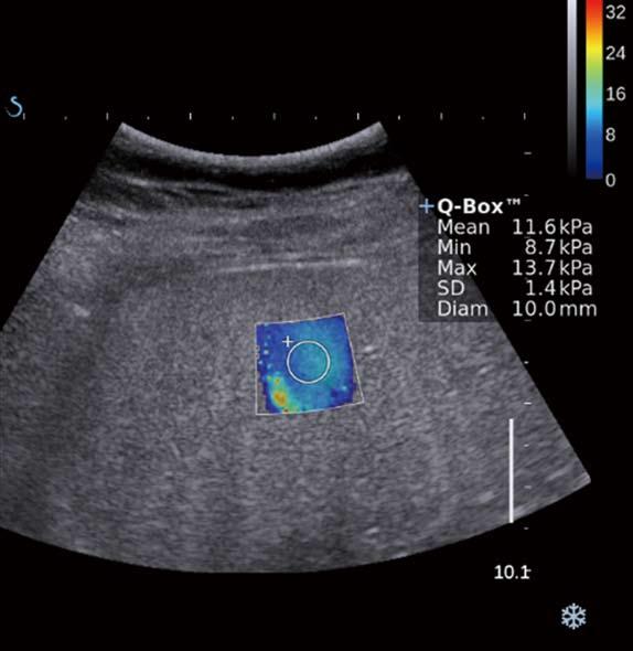 9 kpa, which lies within the normal reference range; B: Supersonic shearwave elastography image of the liver with nonalcoholic steatohepatitis shows an elevated mean liver stiffness value of 11.6 kpa.
