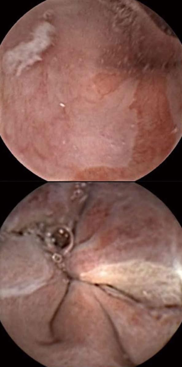 Romero-Vázquez J et al. Capsule endoscopy vs conventional endoscopy A B Figure 7 Suspected Barrett s esophagus (A) and esophageal varices seen (B) with PillCam Colon.