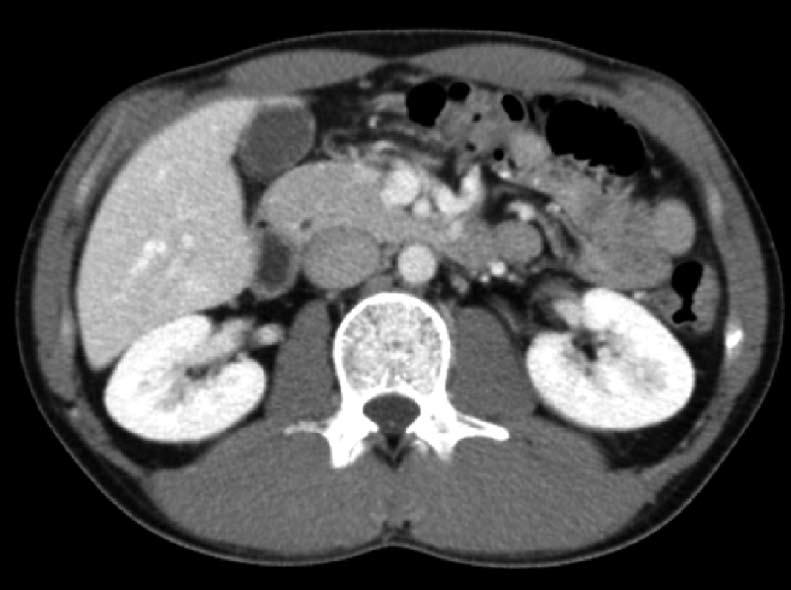 Kobayashi R et al. Acute pancreatitis associated with Campylobacter A Figure 1 Abdominal computed tomography on hospital day 4 revealed mild pancreatic enlargement.