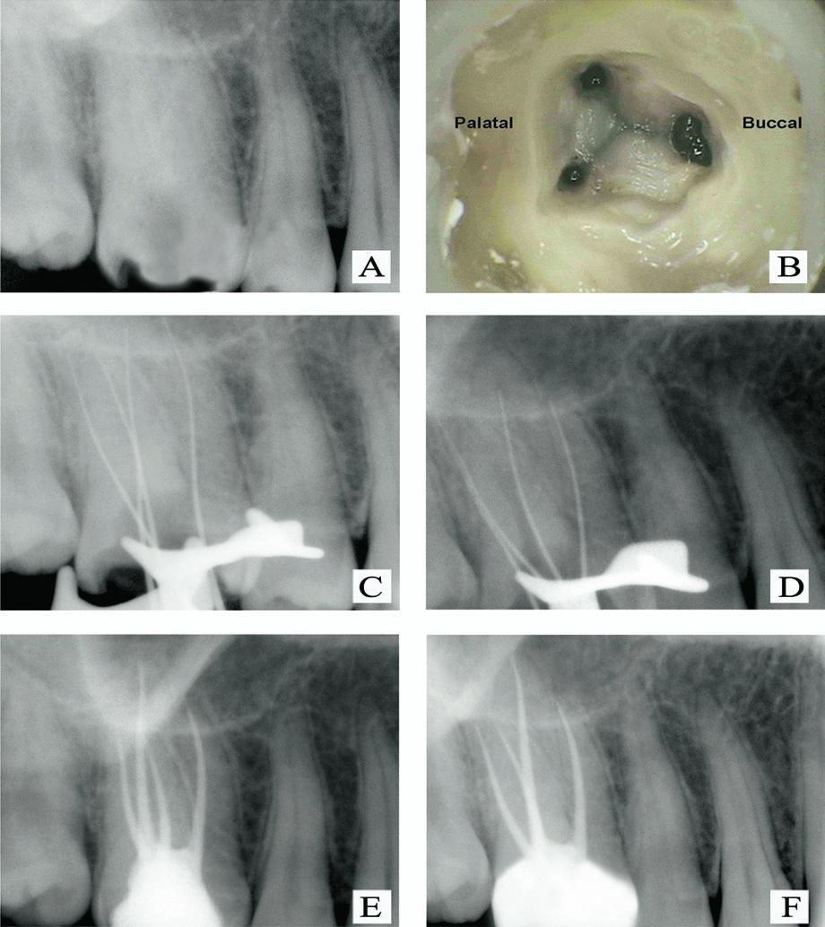 Volume 105, Number 4 Gopikrishna et al. e75 Table I. Review of case reports of extra palatal root in maxillary first molar Reference Study type Key information Barbizam et al.